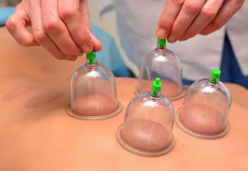 peak-chiropractic-cupping-therapy